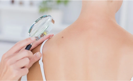 Skin Biopsies