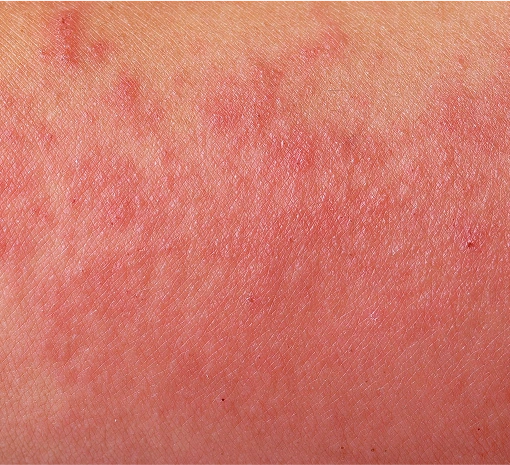 Skin Biopsies