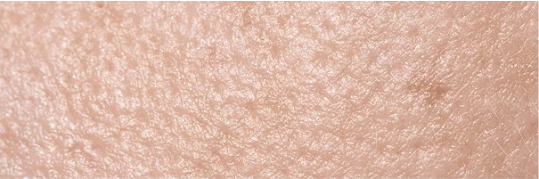 Shave Biopsy