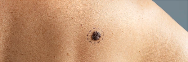 Punch Biopsy